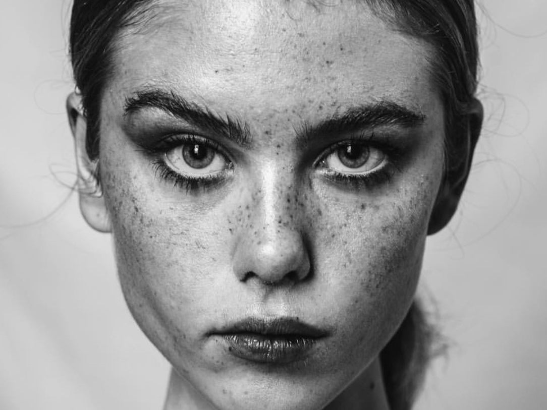 How To Get Freckles